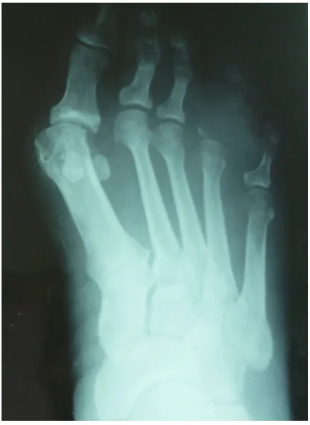 Figure 4: Radiographie  standard  de face  du  pied  droit  montrant une déformation  en  hallux valgus et une  destruction osseuse des phalanges des deux dernies orteils