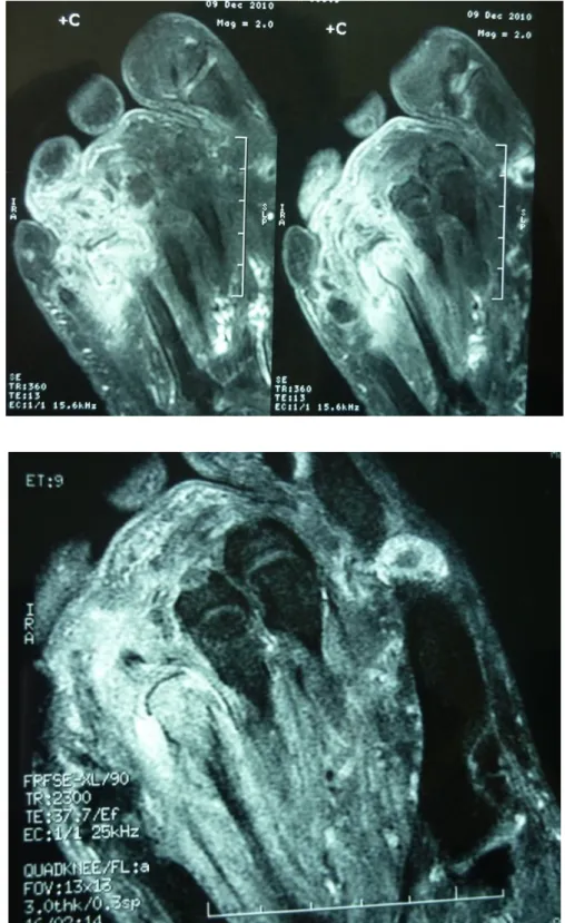 Figure 5 : Imagerie  par  résonance  magnétique  du  pied  droit: processus tumoral  avec envahissement tissulaire et osseux