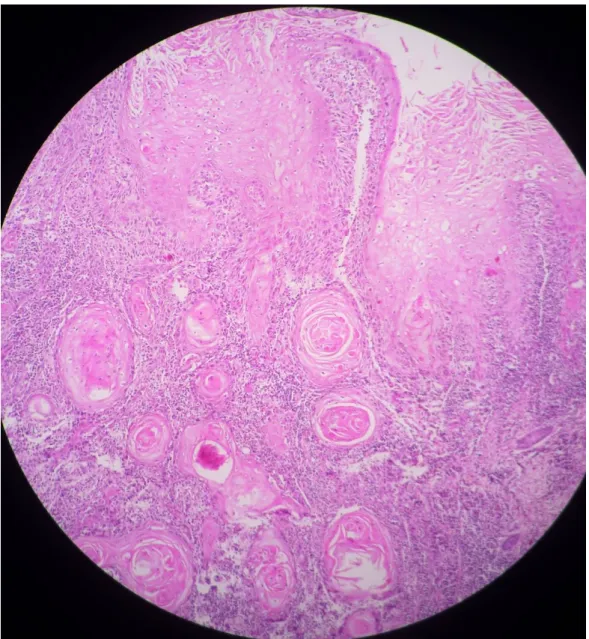 Figure 6 A : HEx40 : Histologie cutanée en faveur d’un carcinome  verruqueux  bien   différencié 