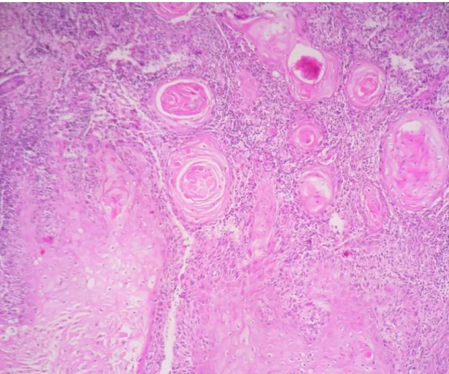 Figure 6 B: HEx40 Histologie cutanée en faveur d’un carcinome verruqueux bien  différencié  