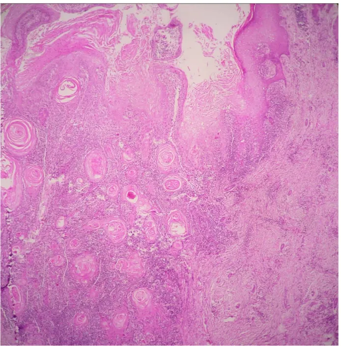 Figure 6 C: HEx40 : Aspect  verruqueux du  revêtement  épidermique  réalisant  des   boyaux  carcinomateux s’invaginant  dans  le  derme,  envahissement  du  derme  profond  et  de  l’hypoderme,  différenciation  malpighienne  avec  élaboration  des  