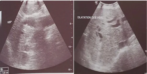 Figure 11 : Dilatation des VBIH et du choledoque sans obstacle individualisable 2) TDM abdominale