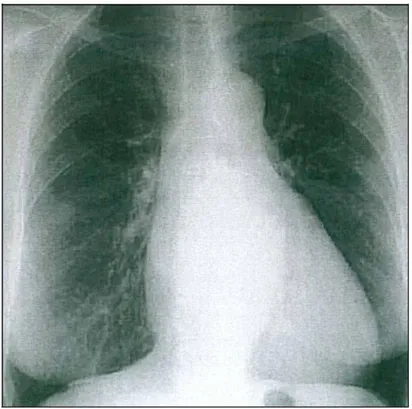 Figure 2 : Radiographie de thorax de face caractérisant le rétrécissement mitral. (Notez la  saillie de l’arc moyen gauche)