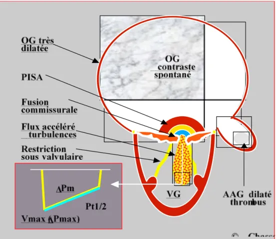 Figure 4: Résumé schématique des caractéristiques échocardiographiques de la sténose  mitrale sévère