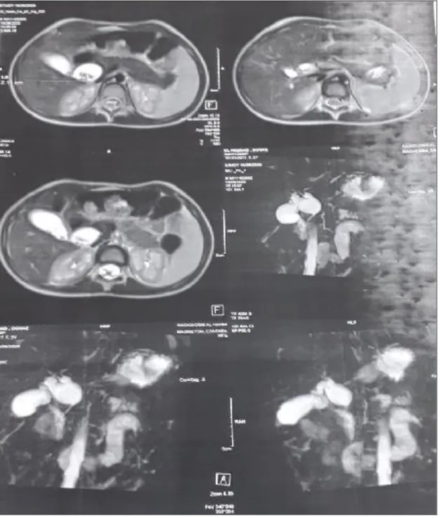 Figure 1:  Bili-IRM objectivant une dilatation kystique du cholédoque classée type IA de  la classification de Todani
