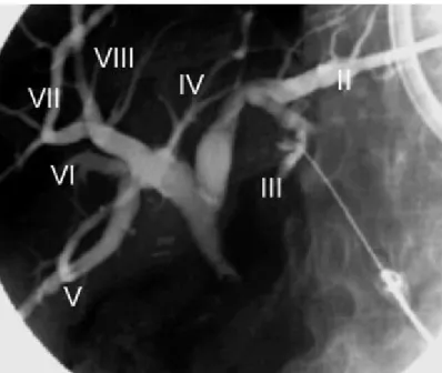 Figure 1. Cholangiographie directe par ponction percutanée de la branche du segment III :  anatomie normale des voies biliaires intra hépatiques et de la convergence