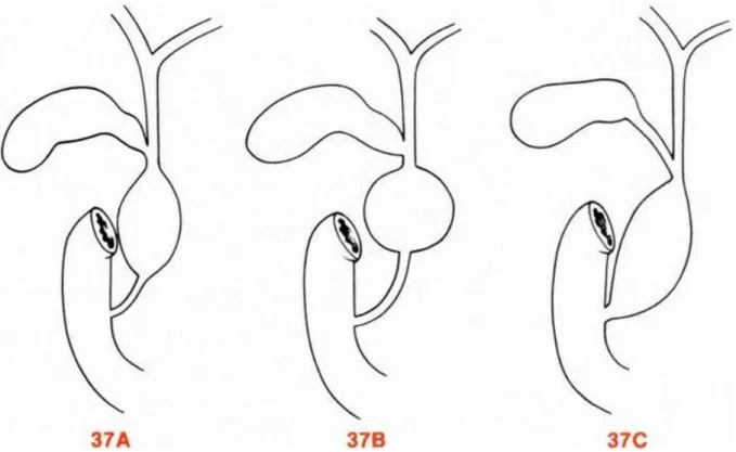Fig 37 : Dilatations kystiques congénitales de la voie biliaire principale. 