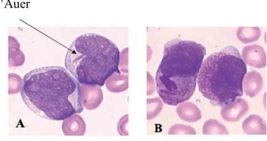 Figure 13 : Leucémie aiguë myéloïde [33]. 