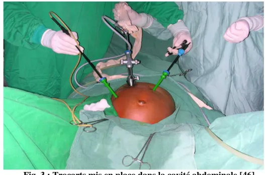 Fig. 3 : Trocarts mis en place dans la cavité abdominale [46]. 