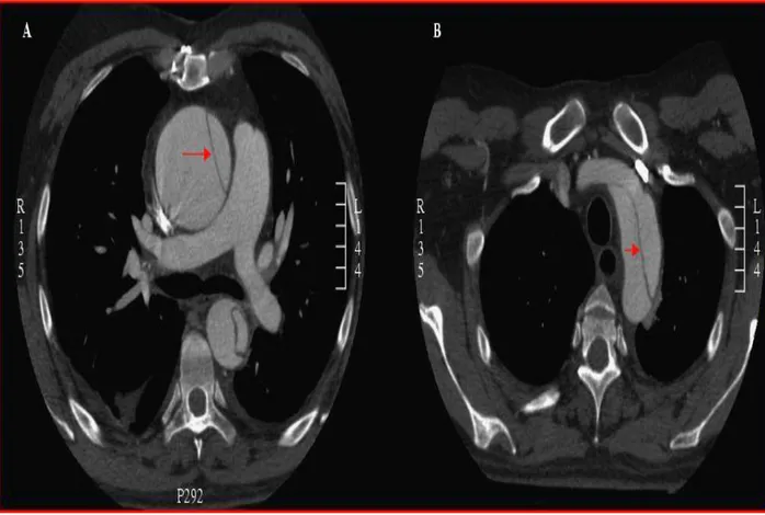 Figure 10: Coupe tomodensitométrique dâune dissection aortique de type A étendue à la crosse  aortique