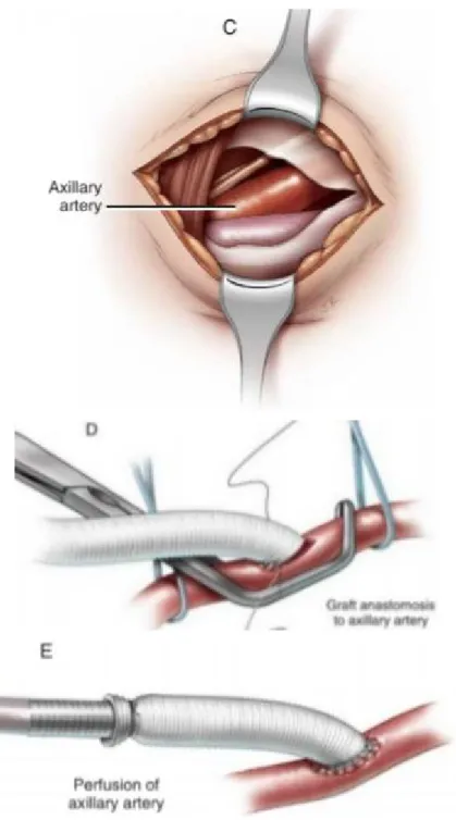 Figure 11: Canulation axillaire (83) 