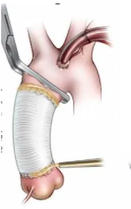Figure 12: Tube sus-coronaire (83) 