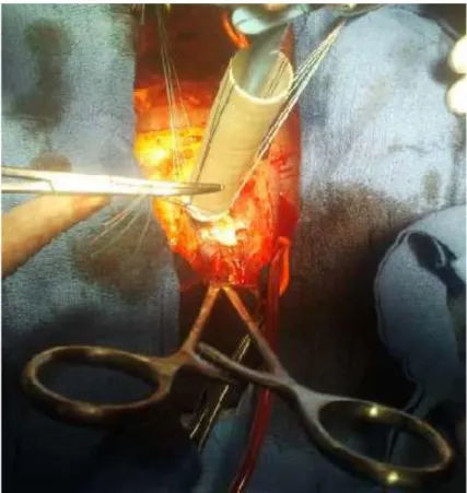 Figure 41 : image montrant le remplacement de l’aorte ascendante par une prothèse en  Dacron selon la technique de Bentall 