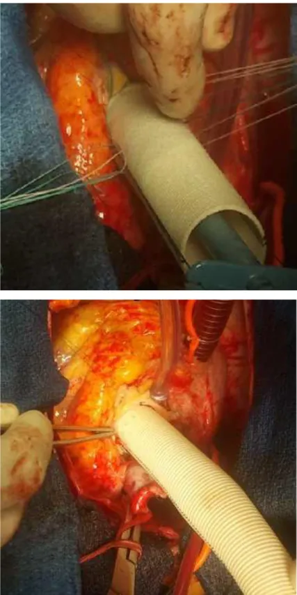 figure 42 : images montrant la réparation proximale selon la technique de Bentall 