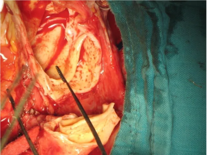 figure 43 : image montrant le vrai et le faux chenal d’une dissection aortique 