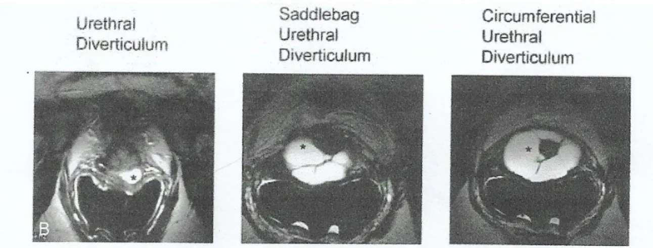 Figure 18: Coupes d'IRM endoluminale  montrant les différents aspects   du DU (simple , en fer à cheval, circonférentiel ) [81] 