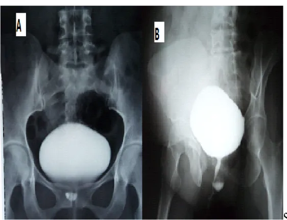 Figure 23  (A+B) : UCG montrant un diverticule sous urétral (service d'urologie A)  -  Une  IRM  a  été  demandée  chez  une  parturiente  ayant  permis  de 