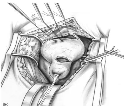 Figure 12 : Diverticulectomie vésicale par voie mixte 
