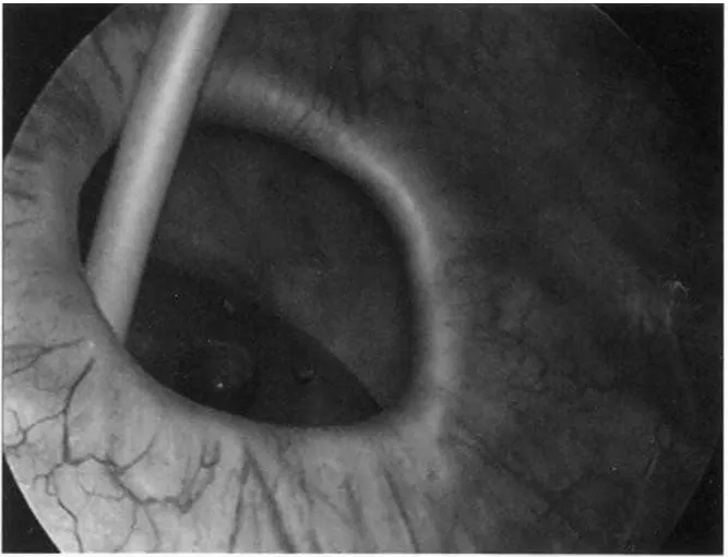 Figure 18  :  Cystogramme montrant un diverticule vésical postérieur de 11 cm.