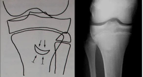 Figure 62 : Aspect irrégulier de la TTA de face apparaissant sous forme d’une image  claire arciforme 