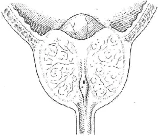 Figure 9 : Adénomectomie rétropubienne. 
