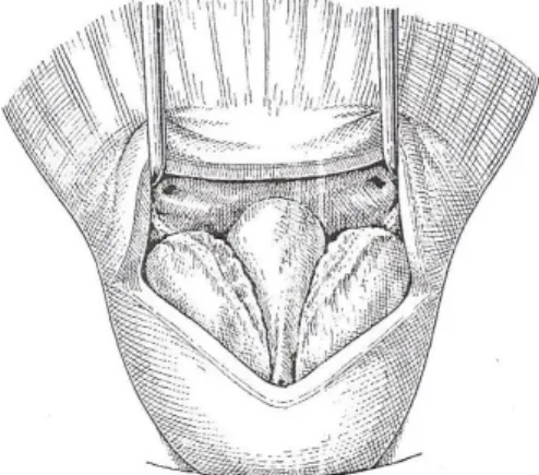Figure 12 : Adénomectomie rétropubienne. Rétraction vers l'avant   de la lèvre antérieure du col