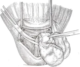 Figure 14 : Adénomectomie rétropubienne. Section aux ciseaux   de la bandelette urétrale  au pôle supérieur du veru montanum