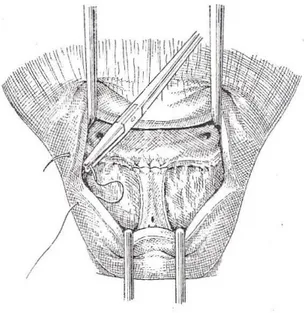 Figure 15 : Adénomectomie rétropubienne 