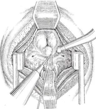Fig. 18. Adénomectomie transvésicale. 
