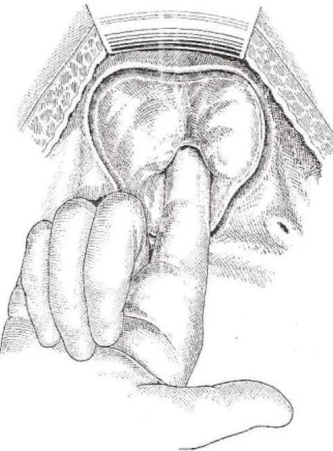 Fig. 19. : Adénomectomie transvésicale. 