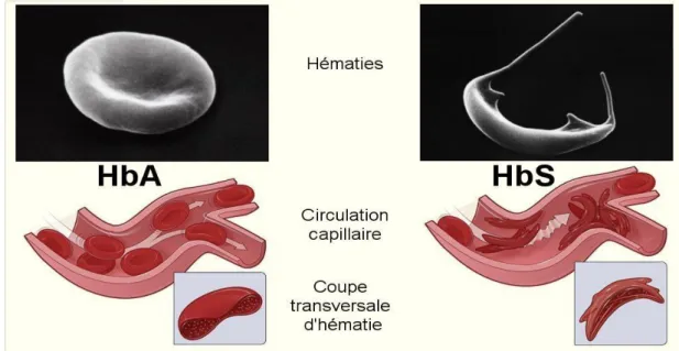 Figure 8 : Comparai  son entre l’HbA normale et l’HbS drépanocytaire [94]. 