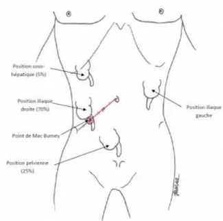 Figure 3: Variations de la position du cæcum et de l’appendice vermiforme. 