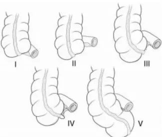 Figure 5: classification de l’agénésie de l’appendice vermiforme 