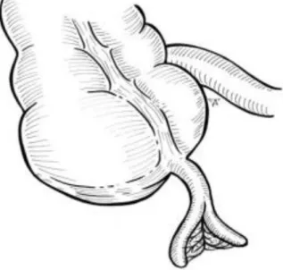 Figure 7:  DA partielle de type A                                               