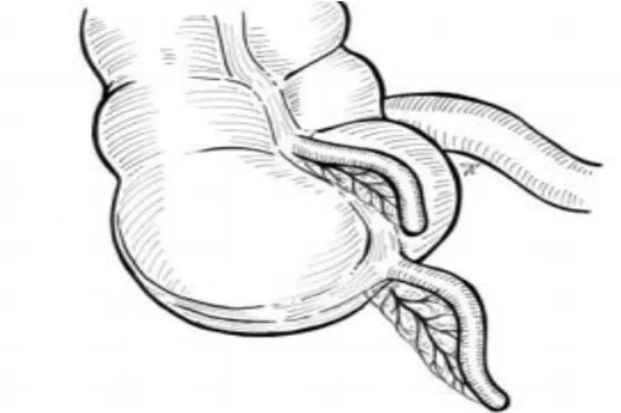 Figure 10: DA de type B2 (tænia coli type)                    
