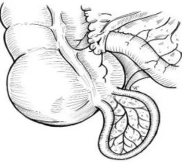 Figure 12: DA en fer à cheval en disposition frontale frontale 