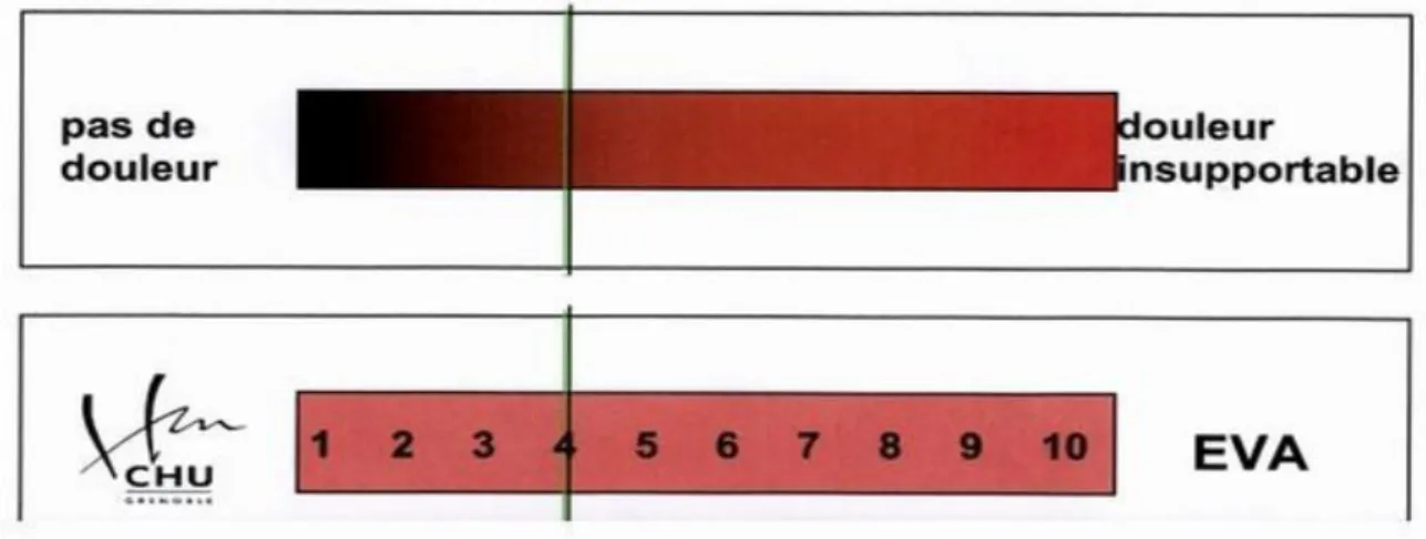 Figure 3 N Echelle Visuelle Analogique EVA de 0 à 1 : indique un simple inconfort : Pas de traitement 