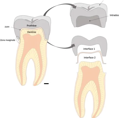 Figure 26 : L’assemblage multicouche de la dent restaurée par une prothèse fixée (ici une couronne)