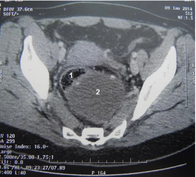 Figure 9  :  TDM abdomino-pelvienne en coupe transversale mettant en                                                                                    évidence le kyste retro-rectal de 9cm (2) comprimant le rectum (1) : 