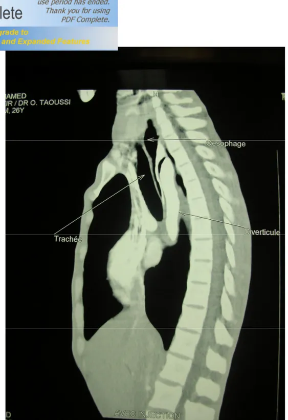 Figure 4: coupe sagittale tomodensitométrique montrant une structure tubulaire retro- retro-œsophagienne comprimant l’œsophage moyen