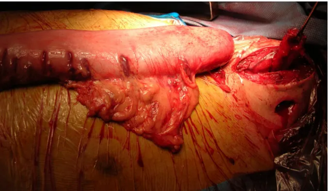 Figure 7: vue opératoire montrant le transplant gastrique tubulisé et le moignon cervical  de l’œsophage