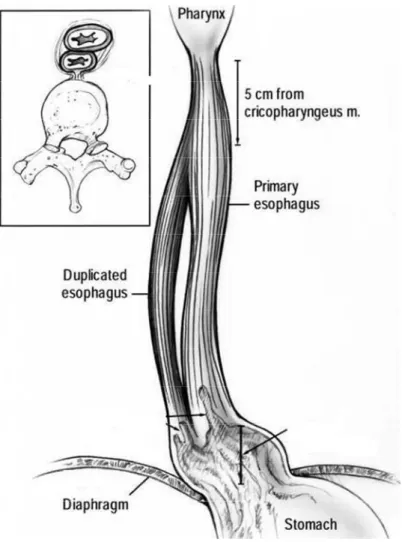 Figure 10: représentation schématique de la duplication tubulaire de l’œsophage chez  notre patient avant la sténose de sa partie distale