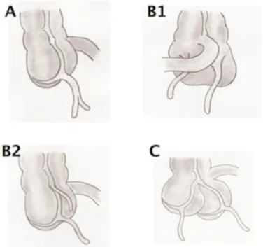 Figure 8 : Classification de Cave-Wallbridge des duplications appendiculaires [22]. 