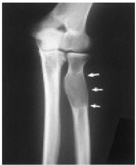 Figure 3: Radiographie  latérale de la jambe montrant 
