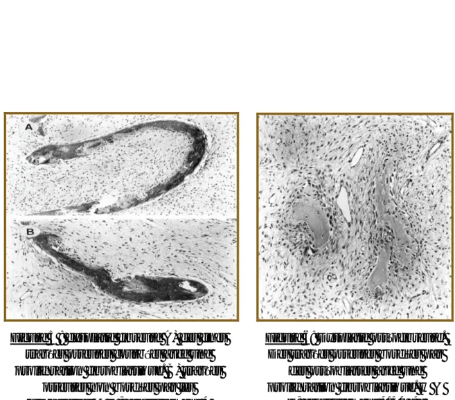 Figure 5 : dysplasie fibreuse A) des fines  travées osseuses courbées avec une  prolifération fibroblastique