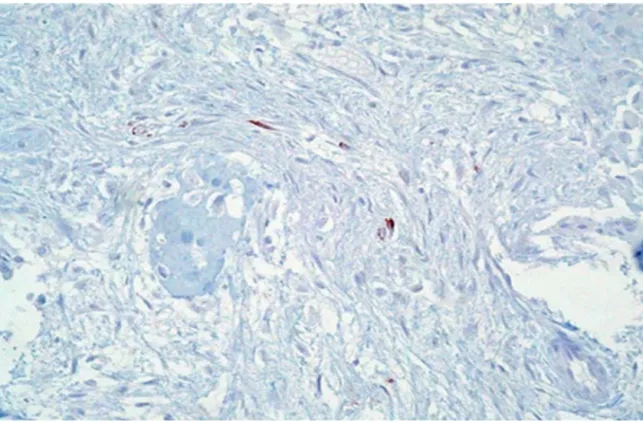Figure 7 : image immunohistochimique montrant quelques cellules épithéliales  cytokératine-positives, suggérant une dysplasie ostéofibreuse.[55] 