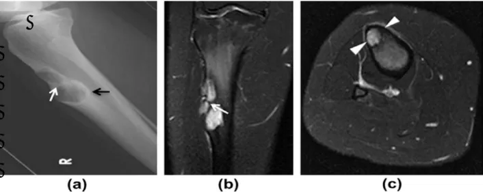 Figure 10: a)image radiologique montrant une lésion ostéolytique étendue intéressant  le cortex tibial antérieur