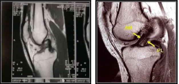 Figure 4:vue IRM de profil qui montre une rupture du LCA. 