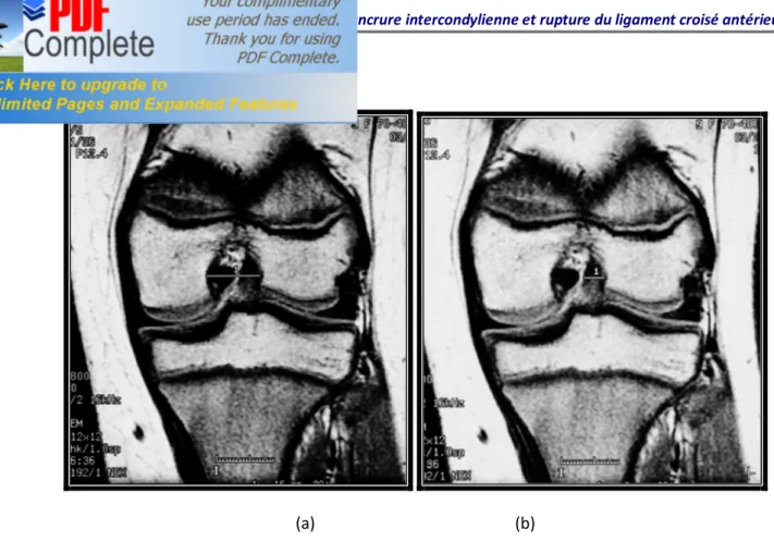 Figure 6 :mensurations IRM de l’échancrure intercondylienne et du ligament croisé antérieur