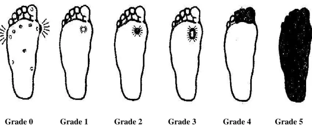 Tableau I : Grades de gravité des lésions du pied diabétique (d'après Wagner)  [30] 